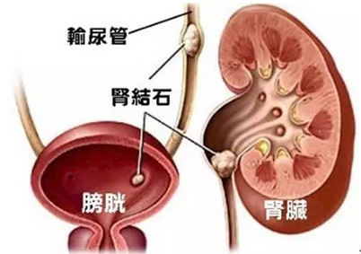 泌尿系結(jié)石